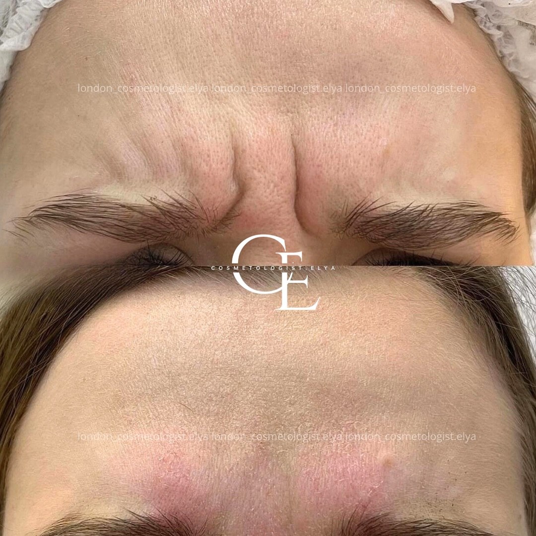 Glabella — before & after