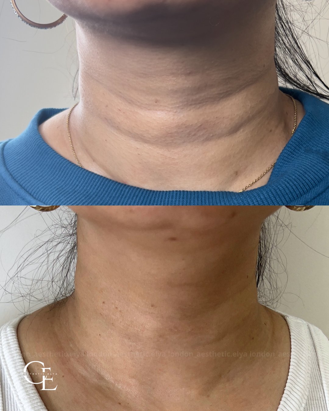 Neck rejuvenation